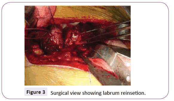 jneuro-labrum-reinsetion