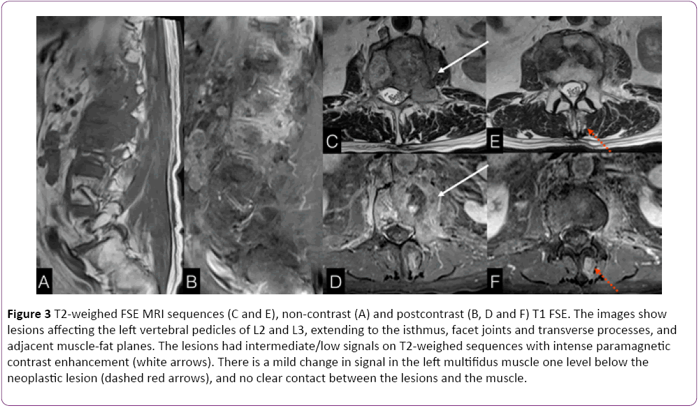 jneuro-left-vertebral-pedicles-isthmus