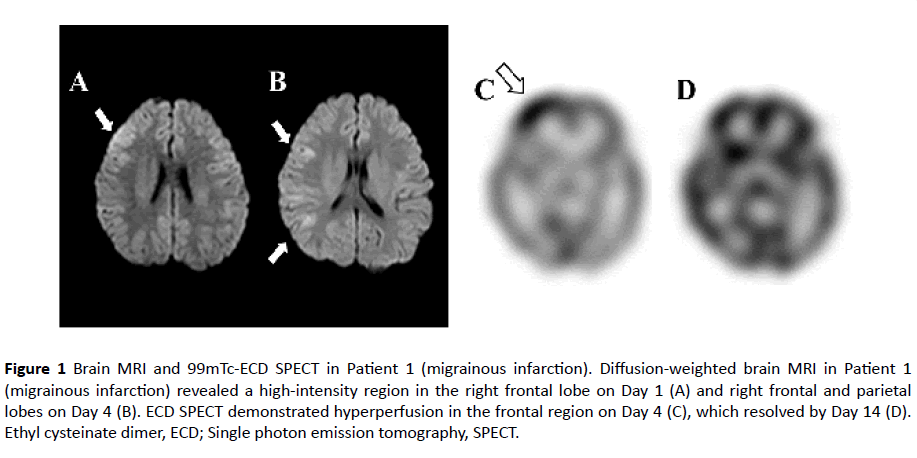 jneuro-migrainous-infarction