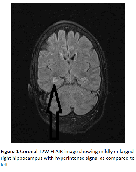 jneuro-mildly-enlarged-right