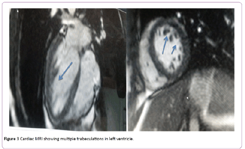 jneuro-multiple-trabeculations