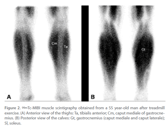 jneuro-muscle-scintigraphy