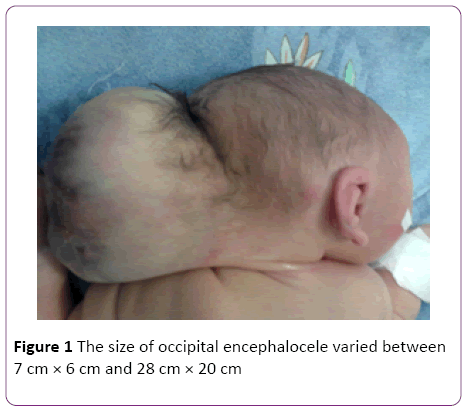 jneuro-occipital-encephalocele