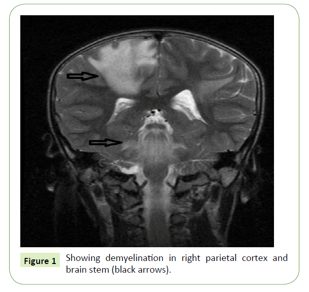 jneuro-parietal-cortex