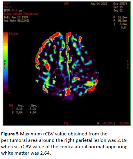 jneuro-parietal-lesion