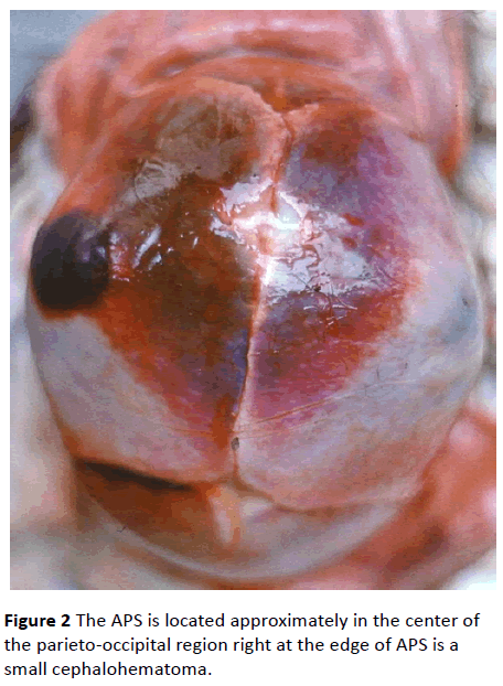 jneuro-parieto-occipital