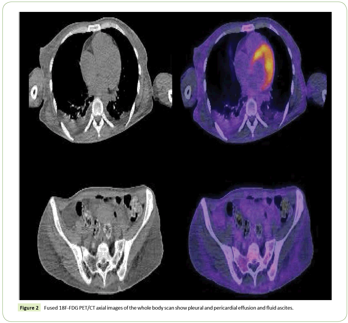 jneuro-pericardial-effusion