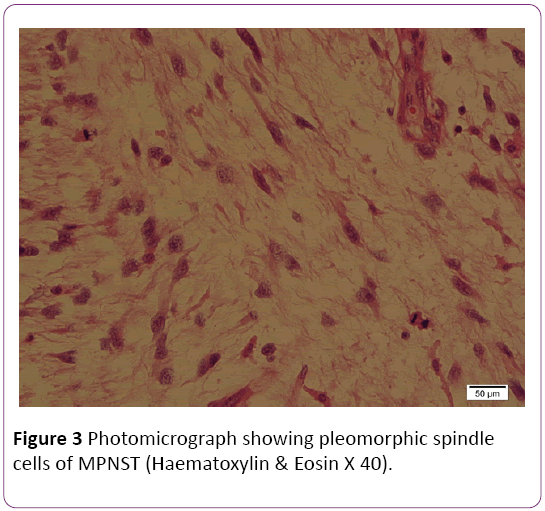 jneuro-pleomorphic-spindle