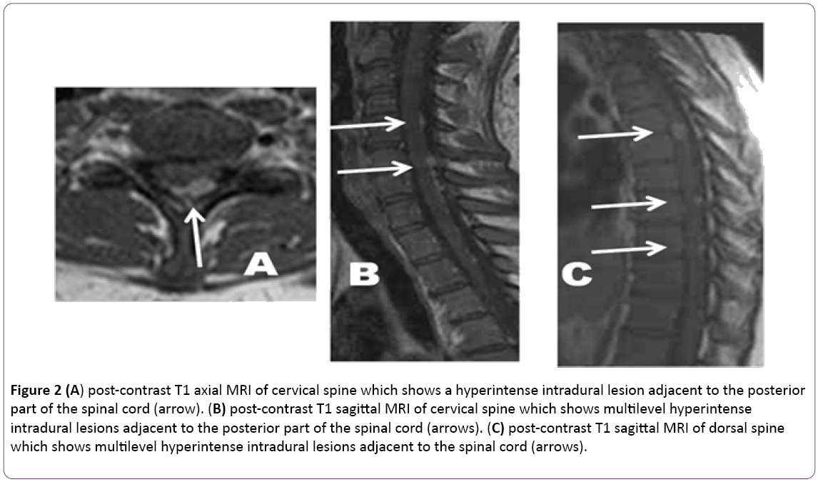 jneuro-post-contrast-T1-axial-MRI