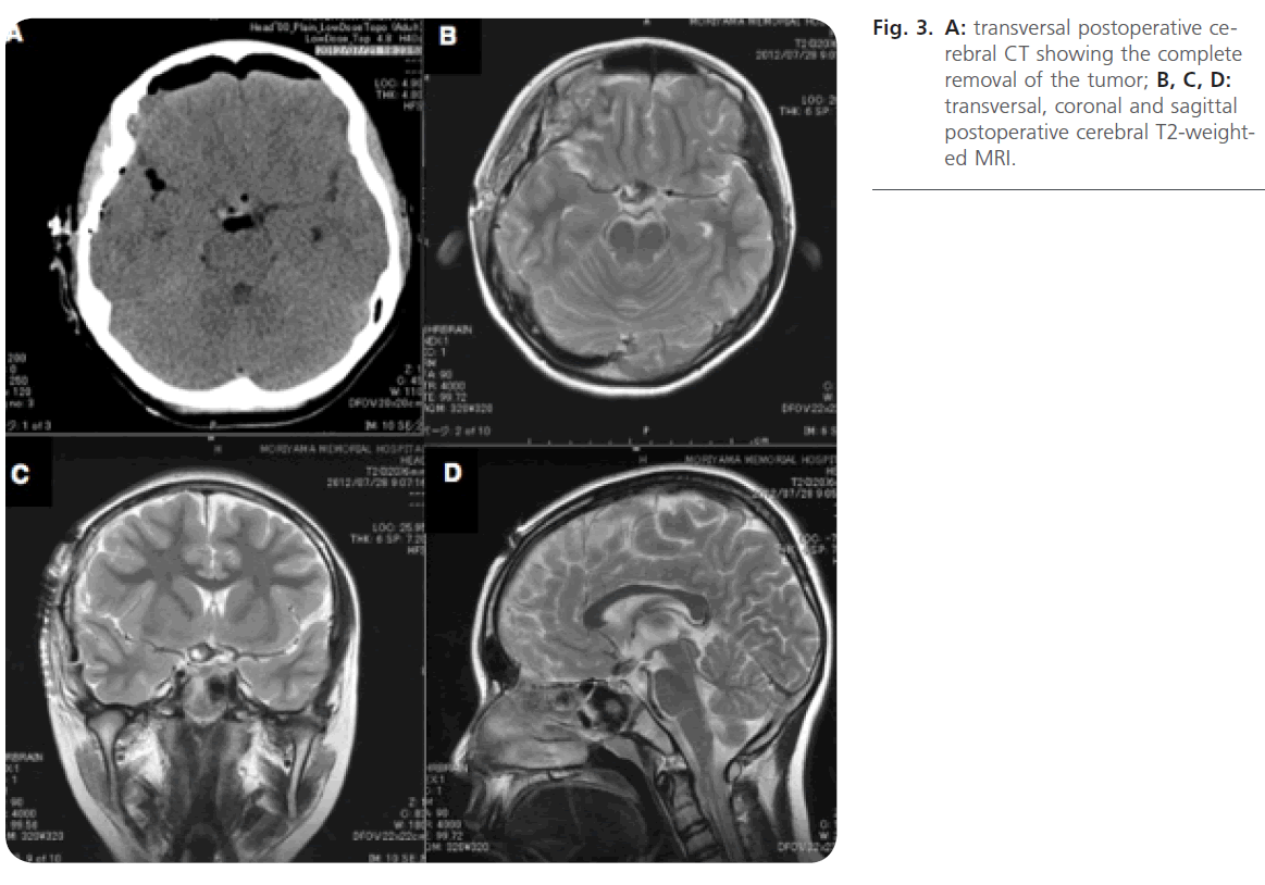 jneuro-postoperative-cerebral