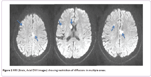 jneuro-restriction-diffusions