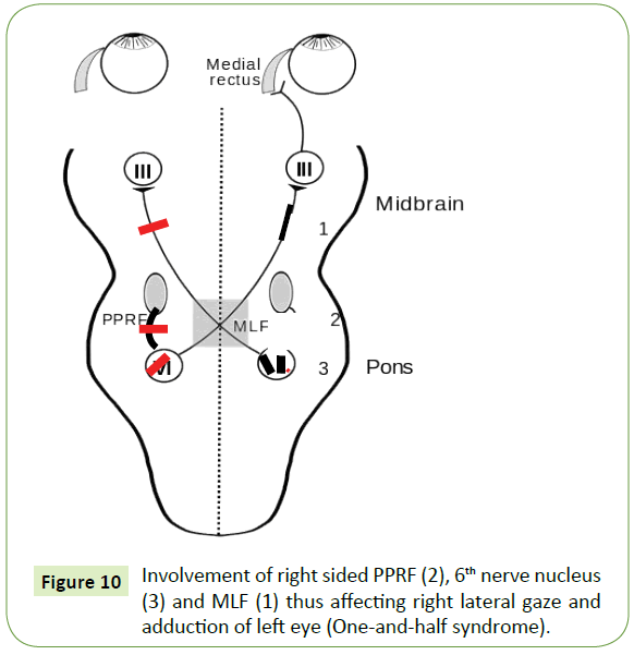 jneuro-right-sided-PPRF