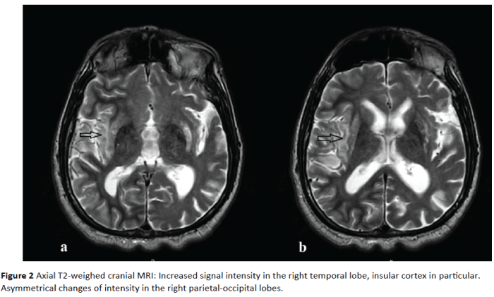 jneuro-right-temporal