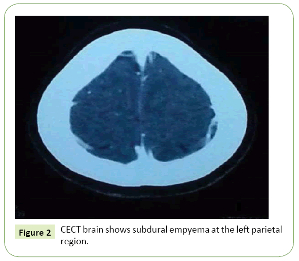 jneuro-subdural-empyema