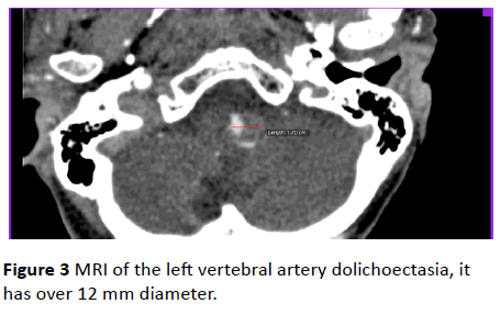 jneuro-vertebral-artery