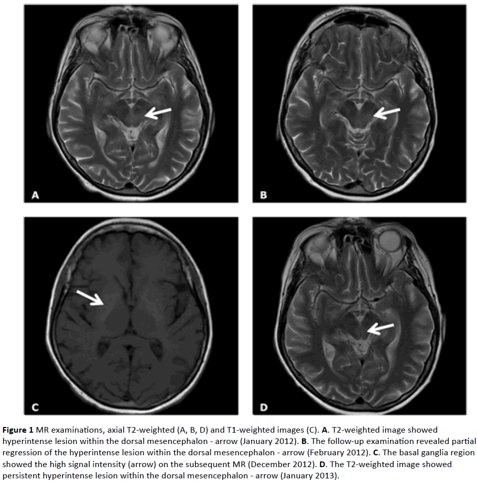 jneuro-weighted-image-showed-hyperintense-lesion