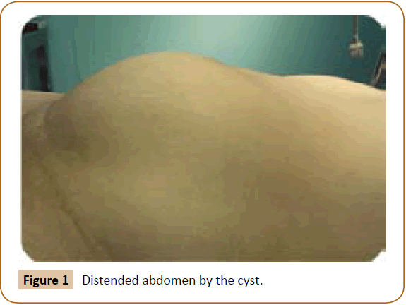 jusurgery-Distended-abdomen