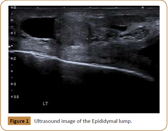 jusurgery-Epididymal-lump