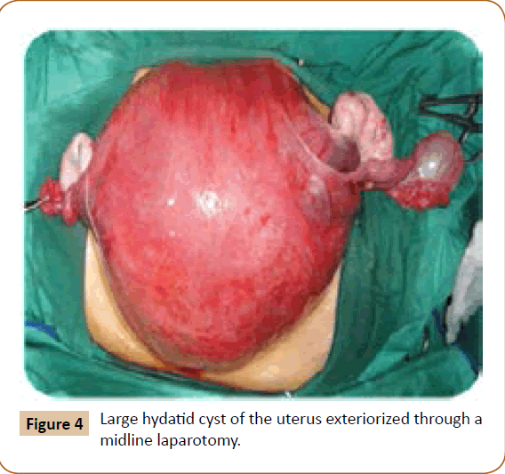 jusurgery-Large-hydatid