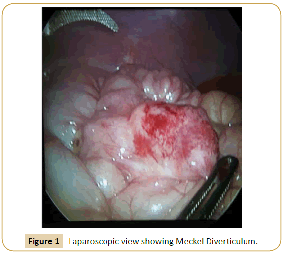 jusurgery-Meckel-Diverticulum