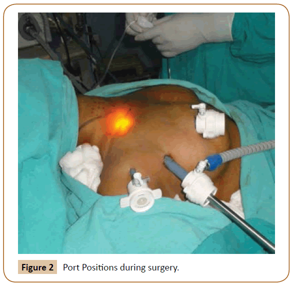 jusurgery-Port-Positions