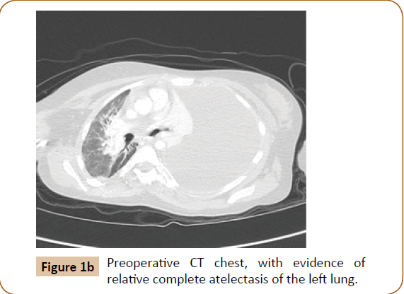 jusurgery-Preoperative-chest