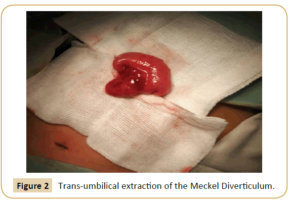 jusurgery-Trans-umbilical