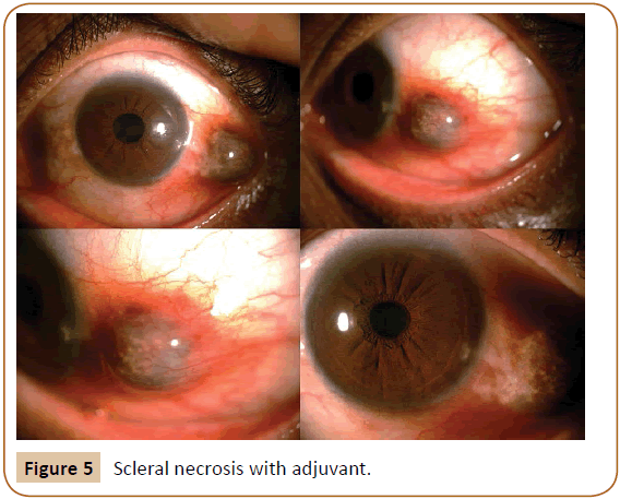 jusurgery-ages-Scleral-necrosis