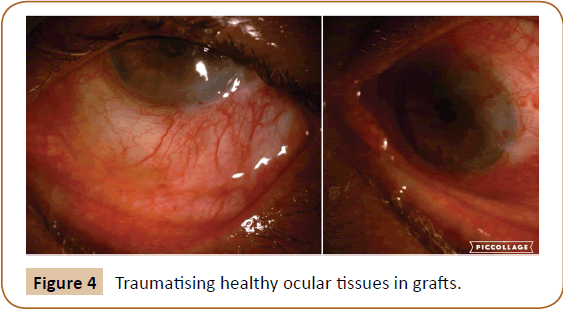 jusurgery-ages-ocular-tissues