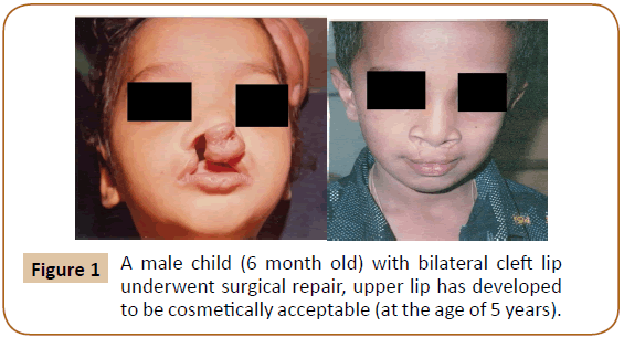 jusurgery-bilateral-cleft