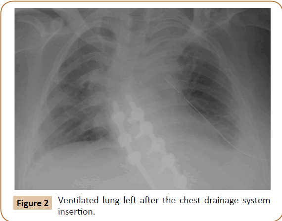 jusurgery-drainage-system