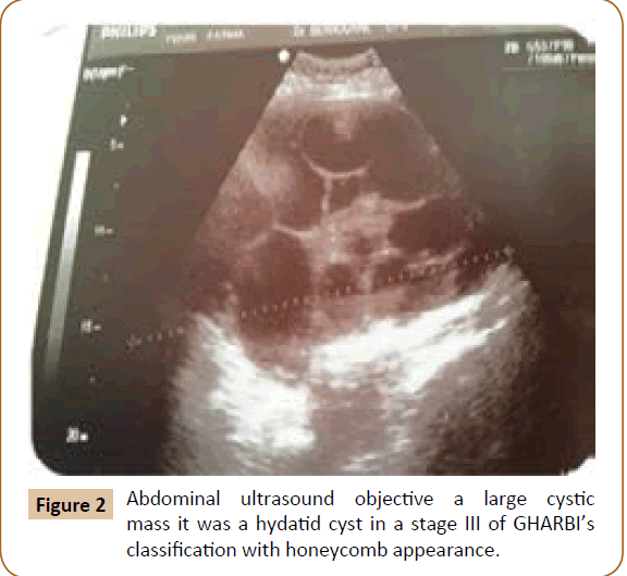 jusurgery-hydatid-cyst