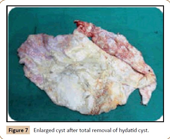 jusurgery-hydatid-cyst