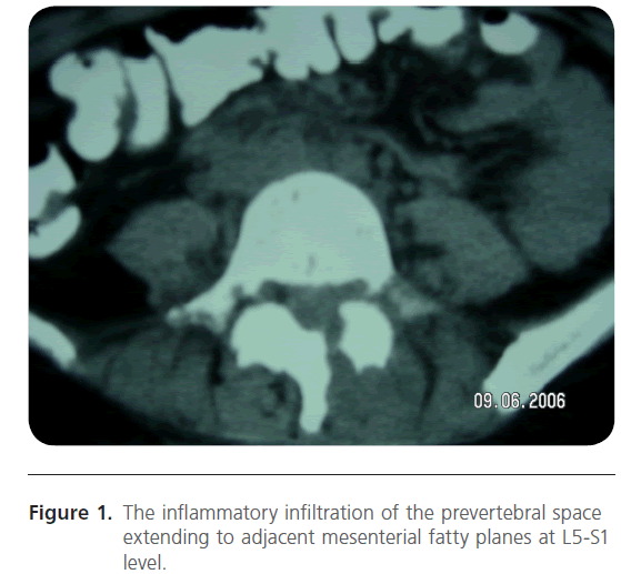 jusurgery-inflammatory