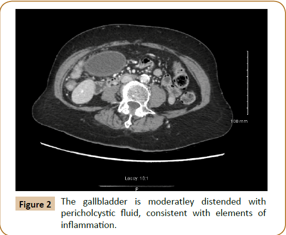 jusurgery-moderatley-distended