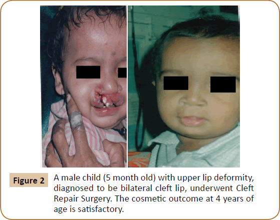 jusurgery-month-old