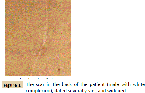 jusurgery-scar-in-the-back