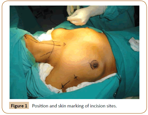 jusurgery-skin-marking