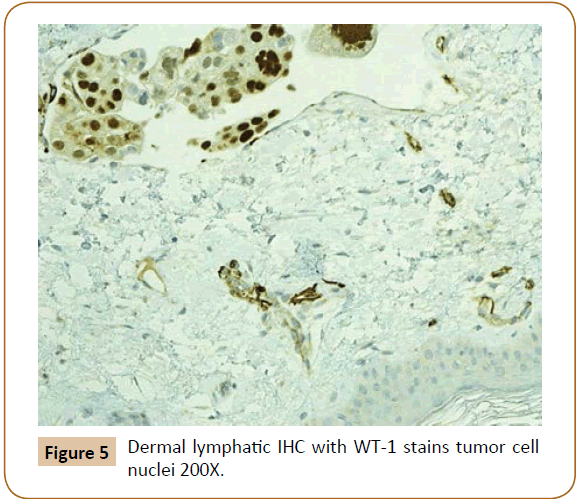 jusurgery-stains-tumor