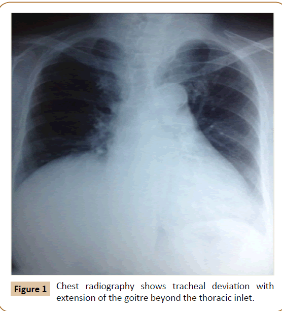 jusurgery-thoracic-inlet