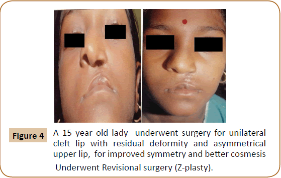 jusurgery-upper-lip