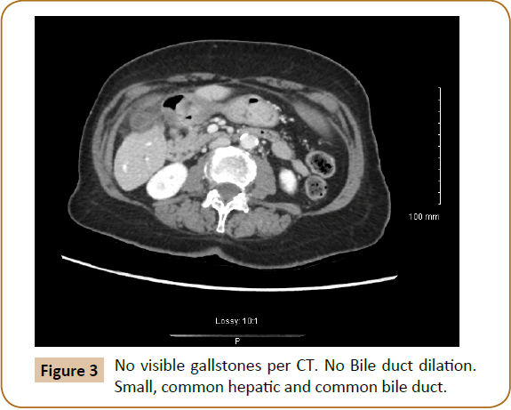 jusurgery-visible-gallstones
