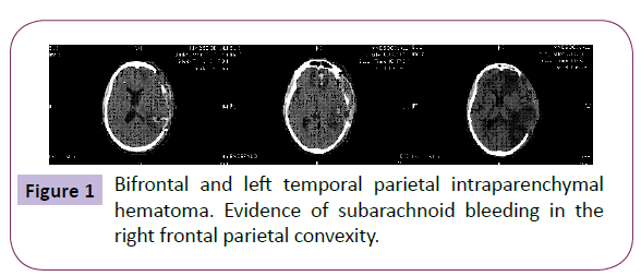 neurology-neuroscience-Bifrontal