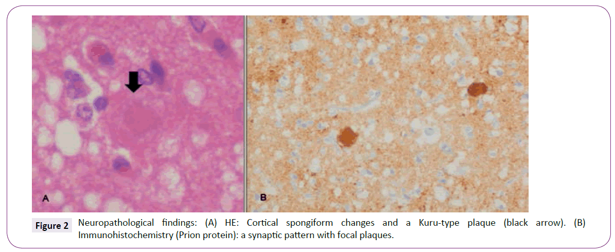 neurology-neuroscience-Neuropathological