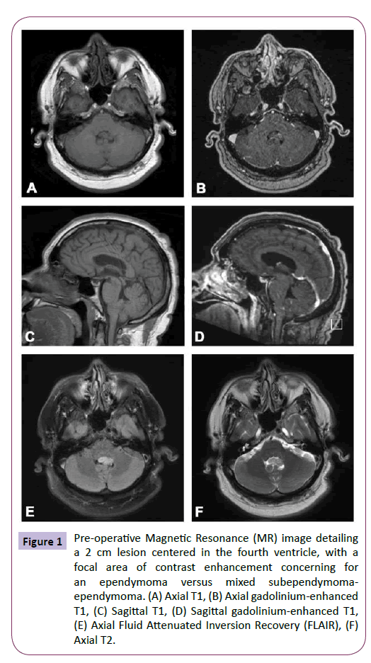 neurology-neuroscience-Pre-operative