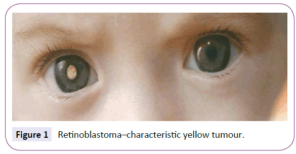 neurology-neuroscience-Retinoblastoma-characteristic