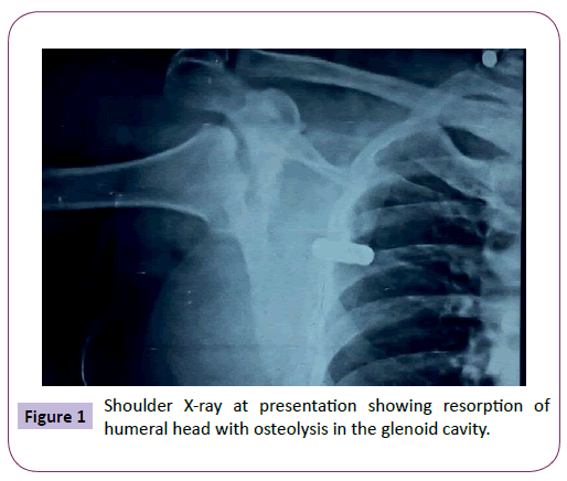 neurology-neuroscience-Shoulder