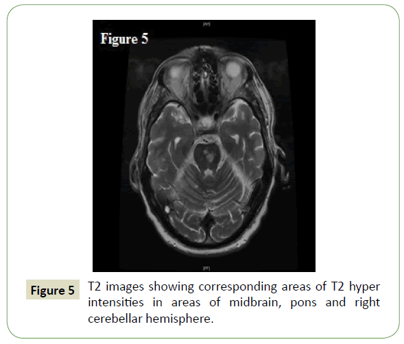 neurology-neuroscience-areas-midbrain