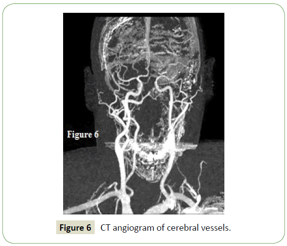 neurology-neuroscience-cerebral-vessels