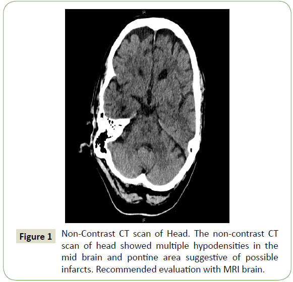 neurology-neuroscience-hypodensities